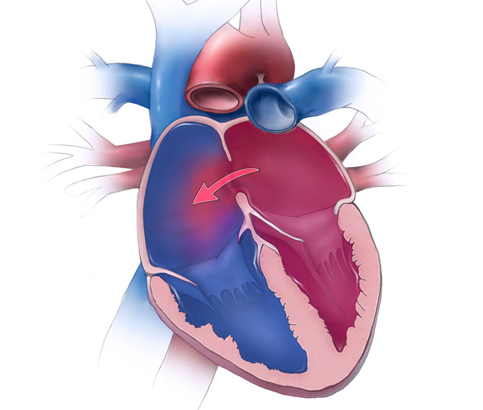 Atrial septal defects dr Alberto Albanese Consultant Cardiac Surgeon International Heart Clinic