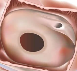 Atrial septal defects before dr Alberto Albanese Consultant Cardiac Surgeon International Heart Clinic