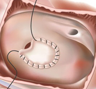 Atrial septal defects after dr Alberto Albanese Consultant Cardiac Surgeon International Heart Clinic