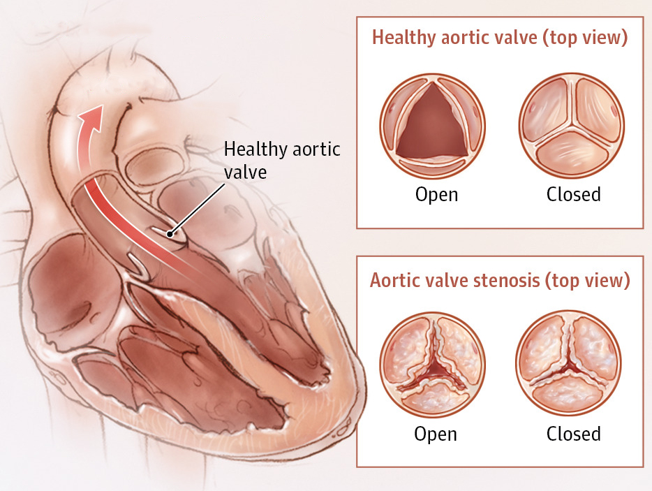 Aortic Valve disease dr Alberto Albanese Consultant Cardiac Surgeon International Heart Clinic