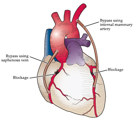 Coronary artery disease (blocked arteries) dr Alberto Albanese Consultant Cardiac Surgeon International Heart Clinic