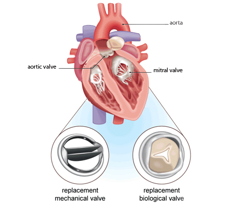 Aortic valve disease replacement dr Alberto Albanese Consultant Cardiac Surgeon International Heart Clinic