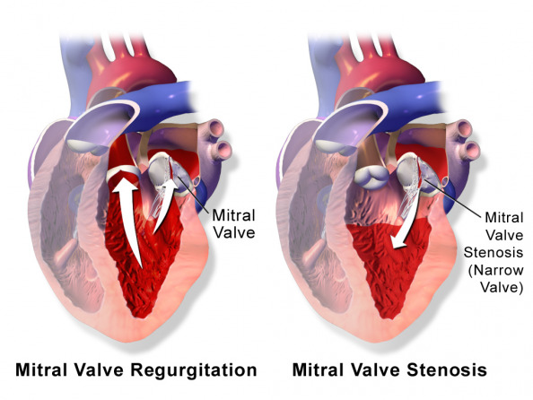 Mitral Valve Disease dr Alberto Albanese Consultant Cardiac Surgeon International Heart Clinic