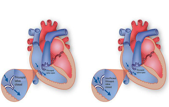 Tricuspid disease dr Alberto Albanese Consultant Cardiac Surgeon International Heart Clinic