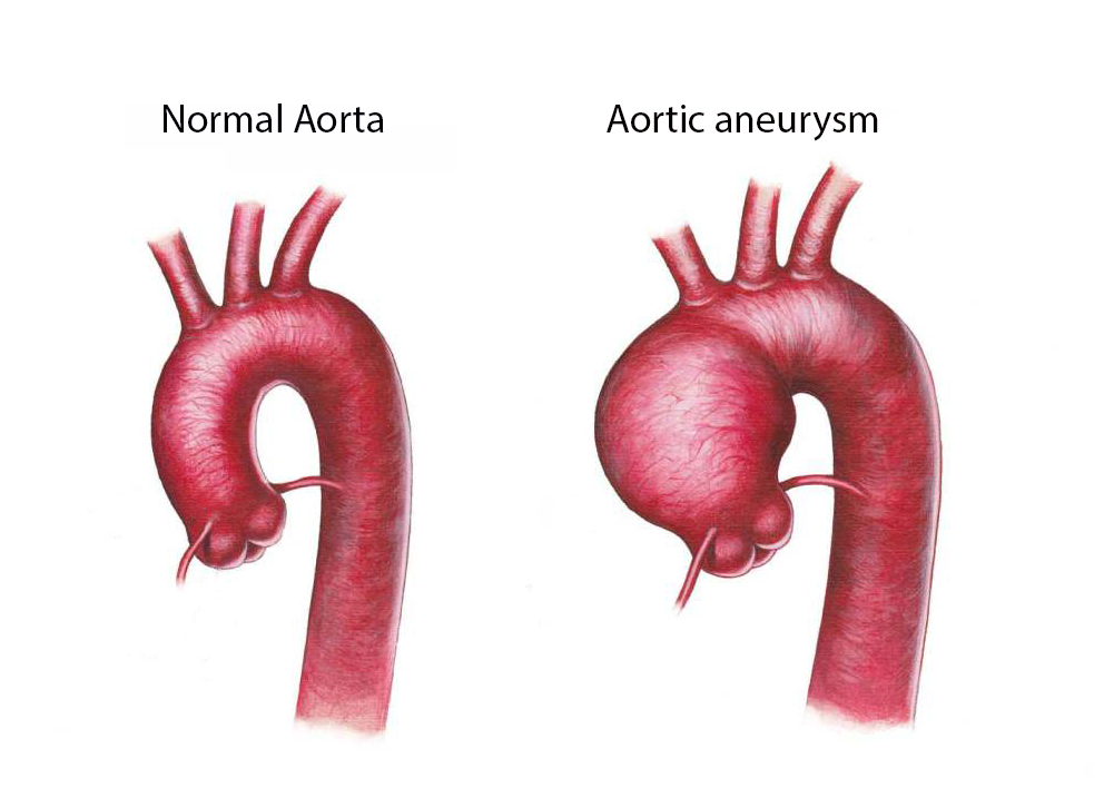 Aortic Aneurysm repair dr Alberto Albanese Consultant Cardiac Surgeon International Heart Clinic