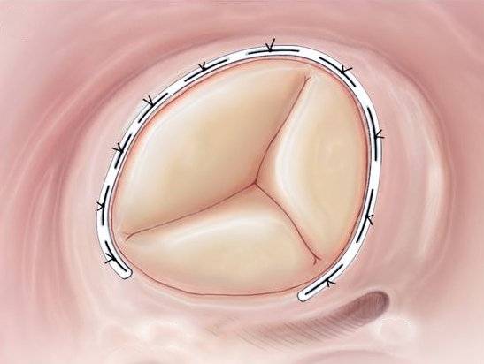 Tricuspid valve disease repair dr Alberto Albanese Consultant Cardiac Surgeon International Heart Clinic