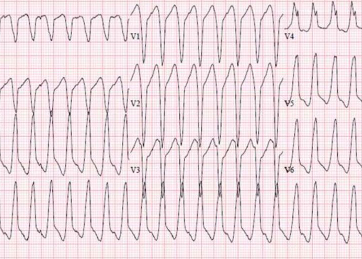 ventricular tachycardia dr Alberto Albanese Consultant Cardiac Surgeon International Heart Clinic