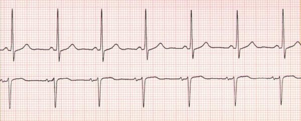 Arrhythmia (irregular heart rhythm) dr Alberto Albanese Consultant Cardiac Surgeon International Heart Clinic