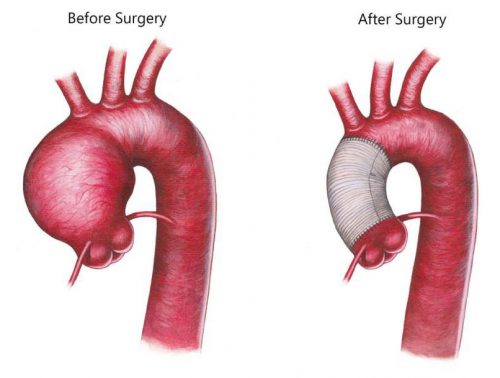 Aortic Aneurysm repair dr Alberto Albanese Consultant Cardiac Surgeon International Heart Clinic