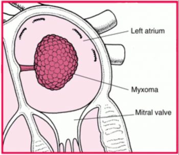 Cardiac tumours dr Alberto Albanese Consultant Cardiac Surgeon International Heart Clinic