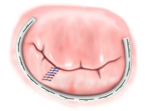 Mitral valve disease repair dr Alberto Albanese Consultant Cardiac Surgeon International Heart Clinic